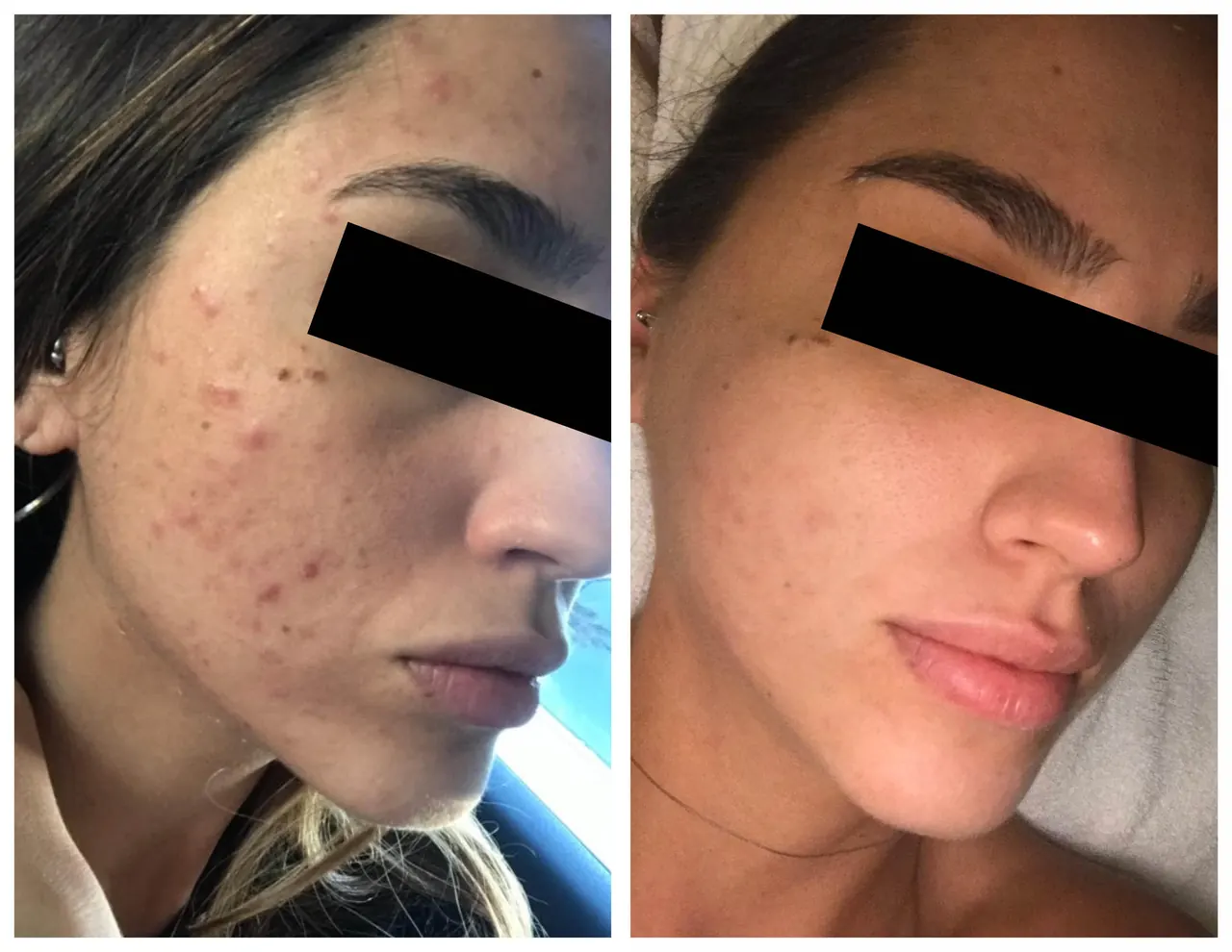 Acne Facial, before and after, Beauty Avenue Las Vegas