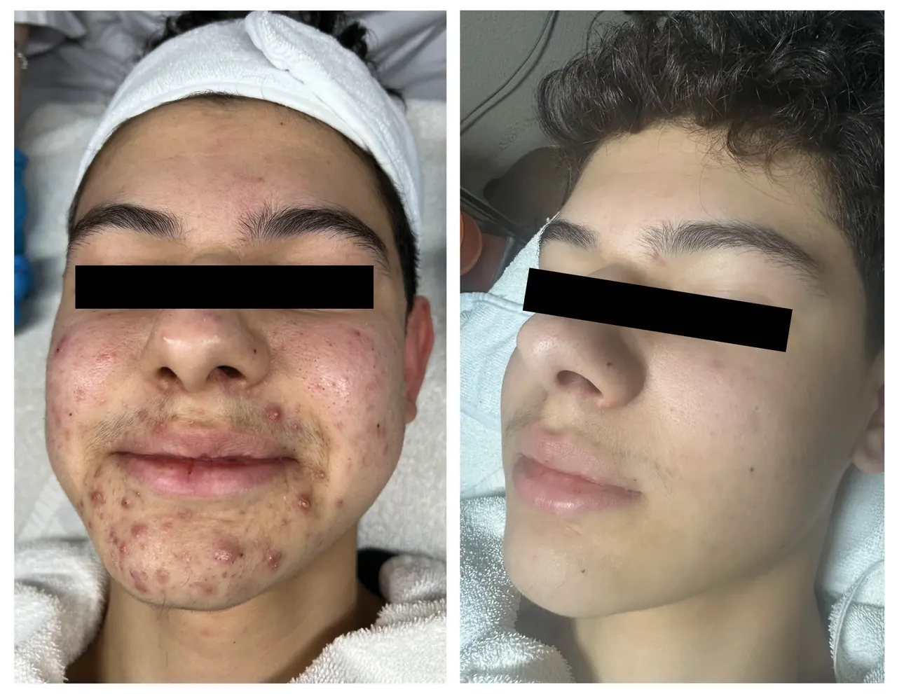 Acne Treatment, before and after, Beauty Avenue Las Vegas