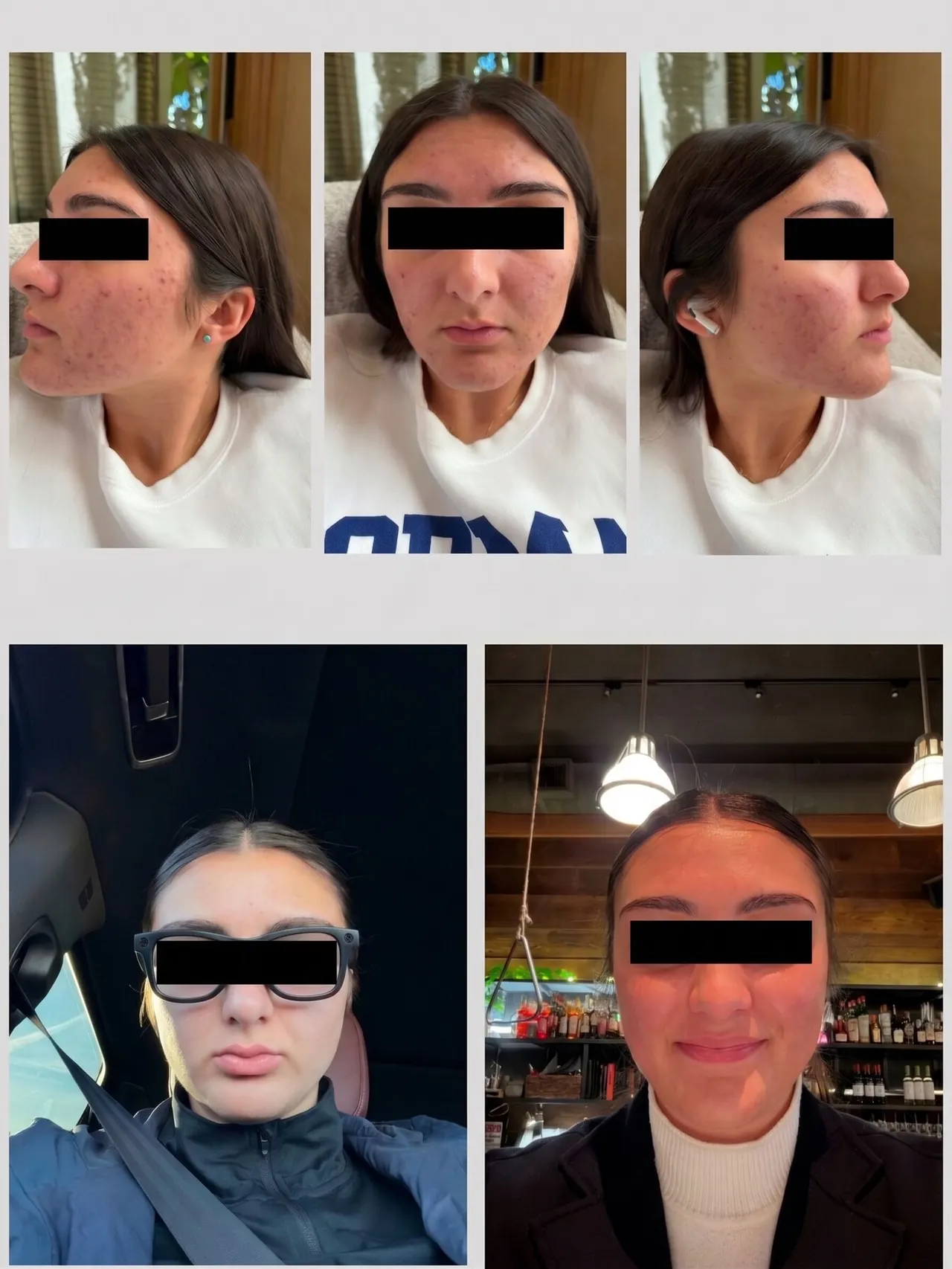 Acne Treatment Before & After, before and after, Beauty Avenue Las Vegas