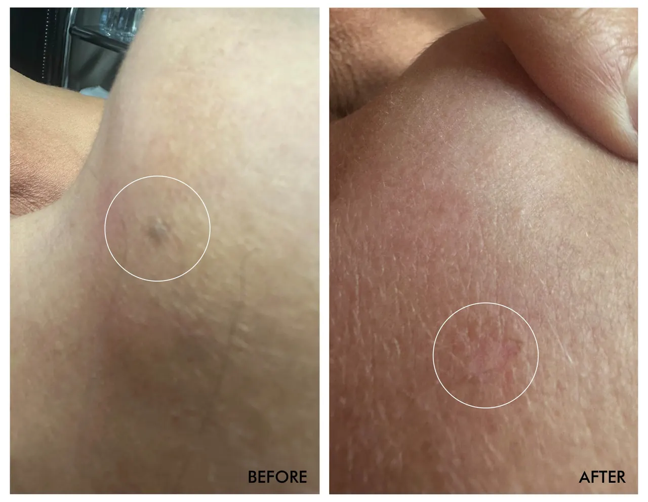 Chin Mole Removal, before and after, Beauty Avenue Las Vegas