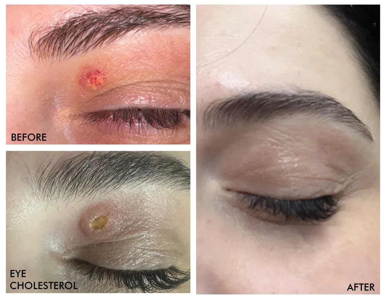 Eye Cholesterol Removal, before and after, Beauty Avenue Las Vegas