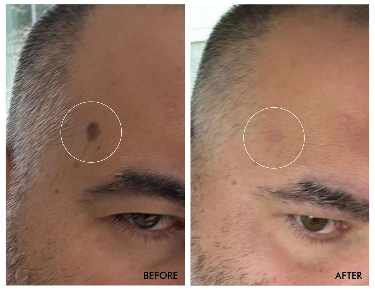 Forehead Mole Removal, before and after, Beauty Avenue Las Vegas