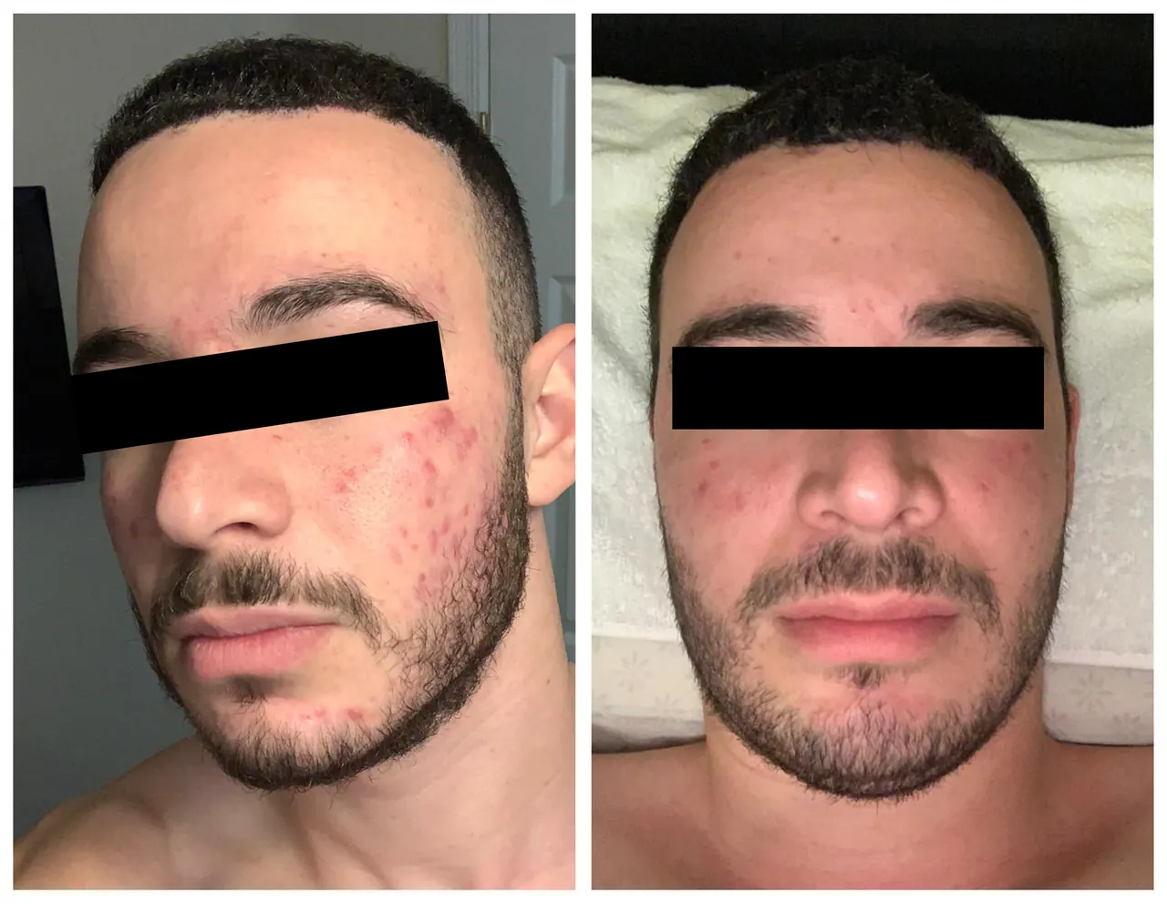 Microneedling, before and after, Beauty Avenue Las Vegas