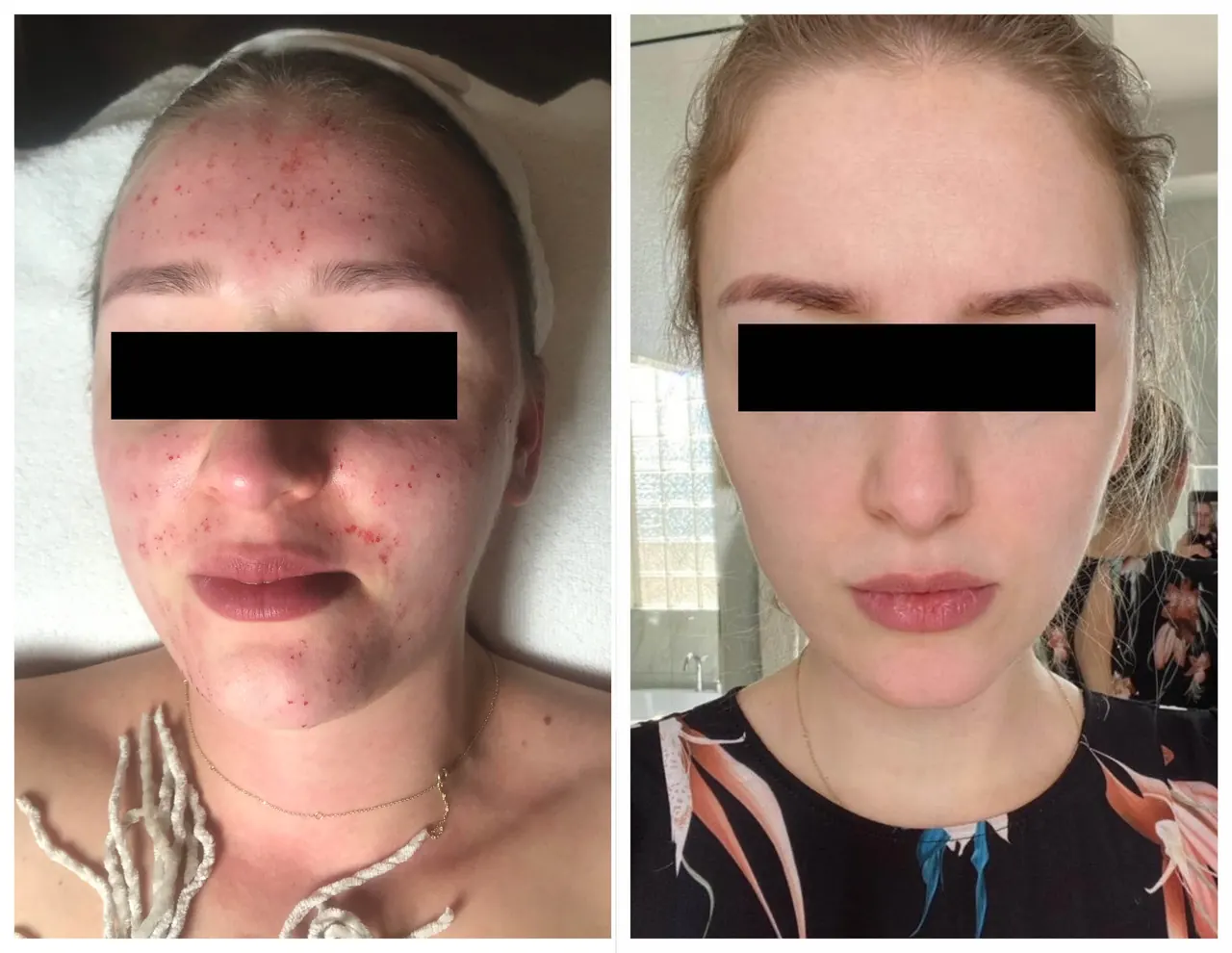 Microneedling, before and after, Beauty Avenue Las Vegas