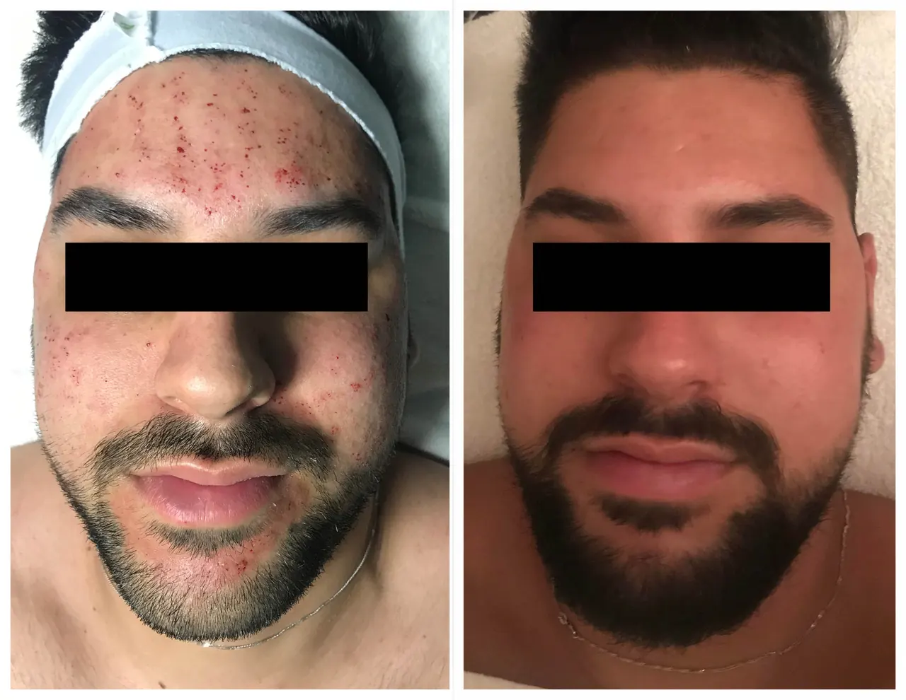 Microneedling, before and after, Beauty Avenue Las Vegas