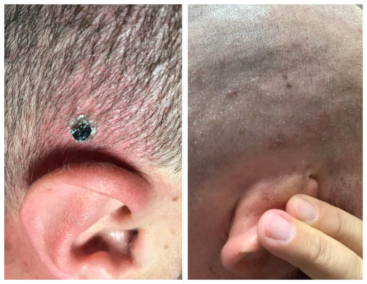 Mole Removal, before and after, Beauty Avenue Las Vegas