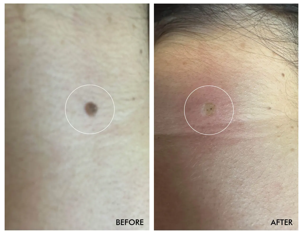 Neck Mole Removal, before and after, Beauty Avenue Las Vegas